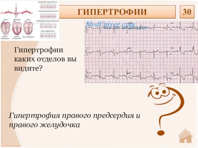 Гипертрофия правого предсердия и правого желудочка Гипертрофии каких отделов вы видите? ГИПЕРТРОФИИ 30