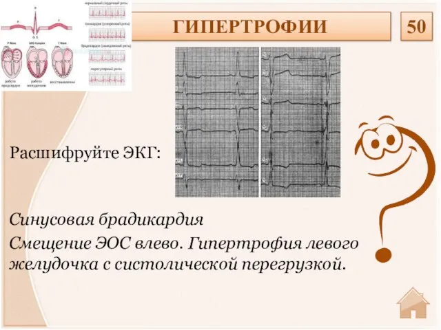 Синусовая брадикардия Смещение ЭОС влево. Гипертрофия левого желудочка с систолической перегрузкой. Расшифруйте ЭКГ: ГИПЕРТРОФИИ 50