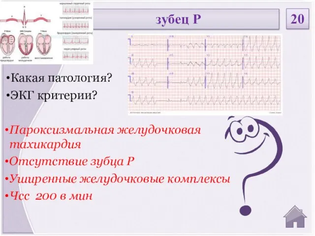 Пароксизмальная желудочковая тахикардия Отсутствие зубца Р Уширенные желудочковые комплексы Чсс 200