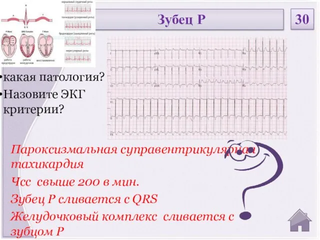 Пароксизмальная суправентрикулярная тахикардия Чсс свыше 200 в мин. Зубец Р сливается