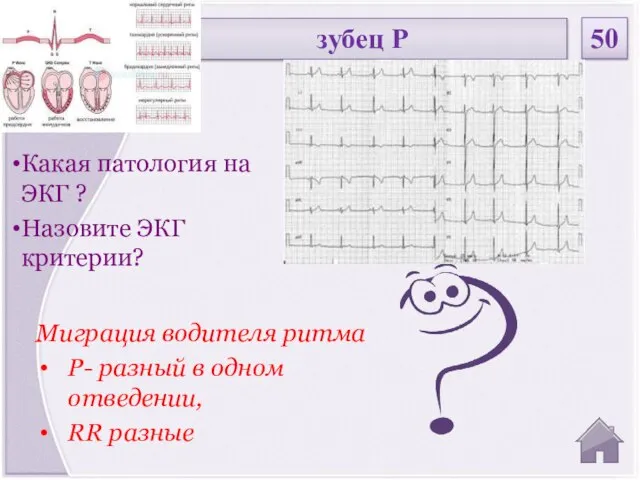 Миграция водителя ритма P- разный в одном отведении, RR разные Какая