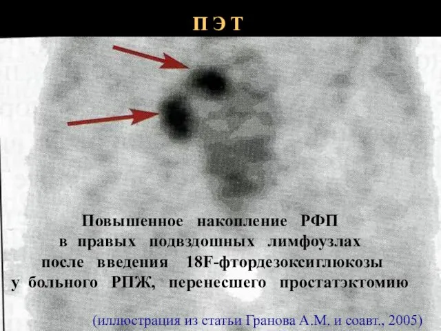 П Э Т Повышенное накопление РФП в правых подвздошных лимфоузлах после