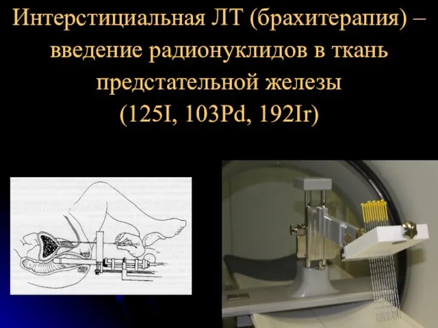 Интерстициальная ЛТ (брахитерапия) – введение радионуклидов в ткань предстательной железы (125I, 103Pd, 192Ir)