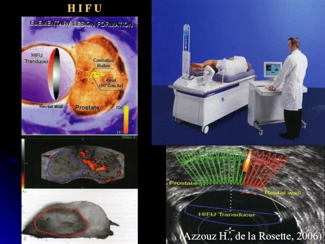 H I F U (Azzouz H., de la Rosette, 2006)