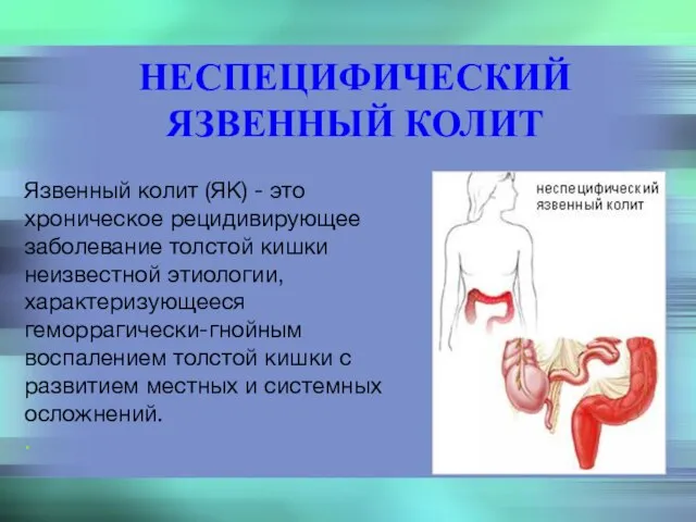 НЕСПЕЦИФИЧЕСКИЙ ЯЗВЕННЫЙ КОЛИТ Язвенный колит (ЯК) - это хроническое рецидивирующее заболевание