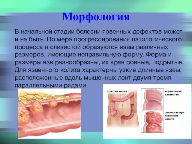 Морфология В начальной стадии болезни язвенных дефектов может и не быть.