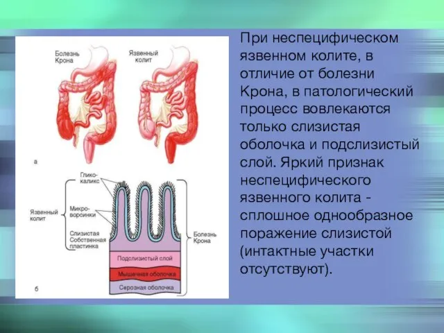 При неспецифическом язвенном колите, в отличие от болезни Крона, в патологический