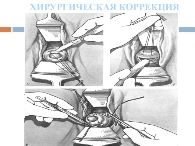 ХИРУРГИЧЕСКАЯ КОРРЕКЦИЯ ИЦН