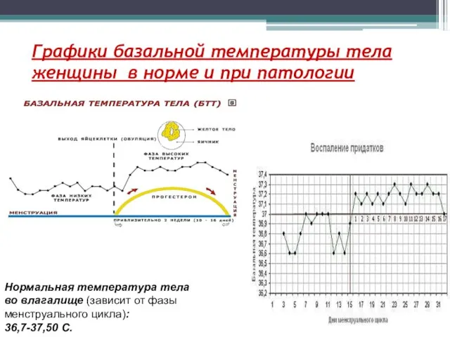 Графики базальной температуры тела женщины в норме и при патологии Нормальная