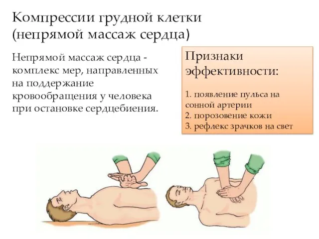 Компрессии грудной клетки (непрямой массаж сердца) Непрямой массаж сердца - комплекс