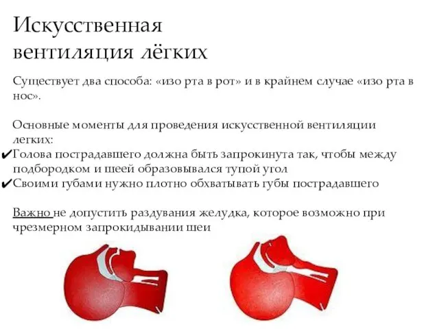 Искусственная вентиляция лёгких Существует два способа: «изо рта в рот» и