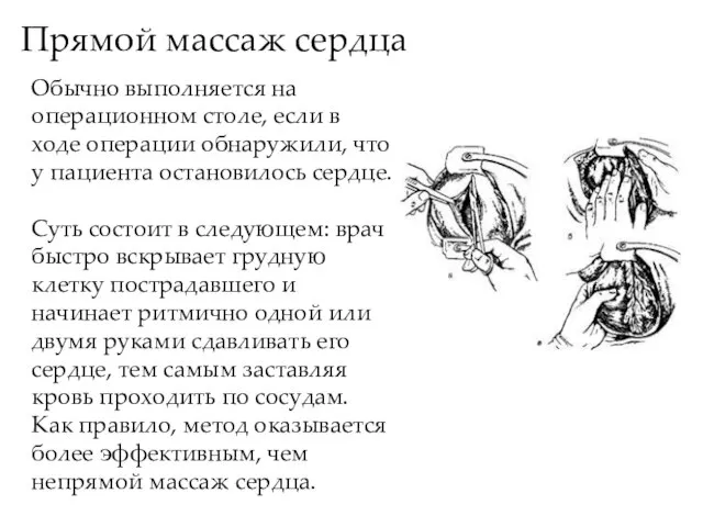 Прямой массаж сердца Обычно выполняется на операционном столе, если в ходе