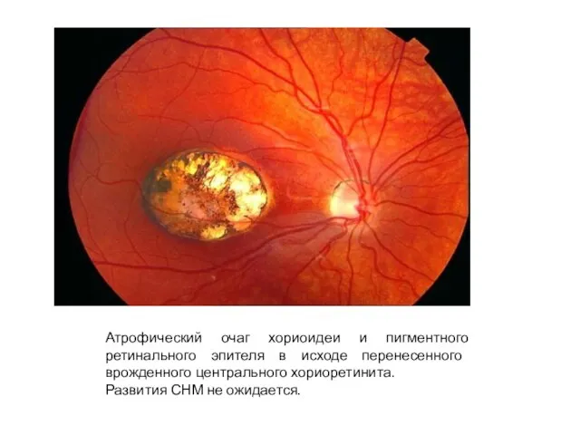 Атрофический очаг хориоидеи и пигментного ретинального эпителя в исходе перенесенного врожденного