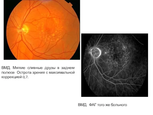 ВМД ВМД. Мягкие сливные друзы в заднем полюсе Острота зрения с