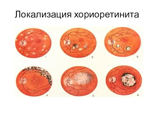 Локализация хориоретинита