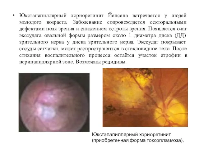 Юкстапапиллярный хориоретинит Йенсена встречается у людей молодого возраста. Заболевание сопровождается секторальными