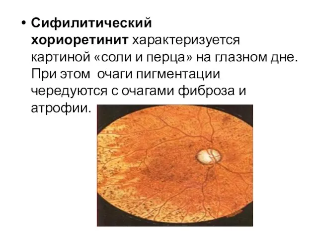 Сифилитический хориоретинит характеризуется картиной «соли и перца» на глазном дне. При