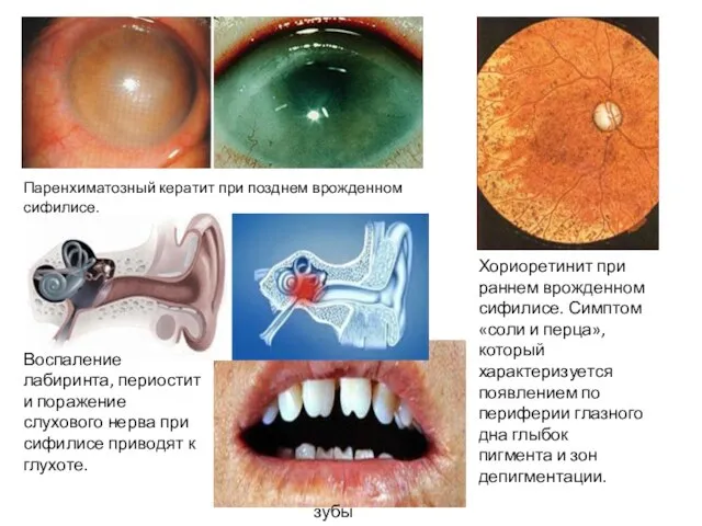 Паренхиматозный кератит при позднем врожденном сифилисе. зубы Гетчинсона. Хориоретинит при раннем