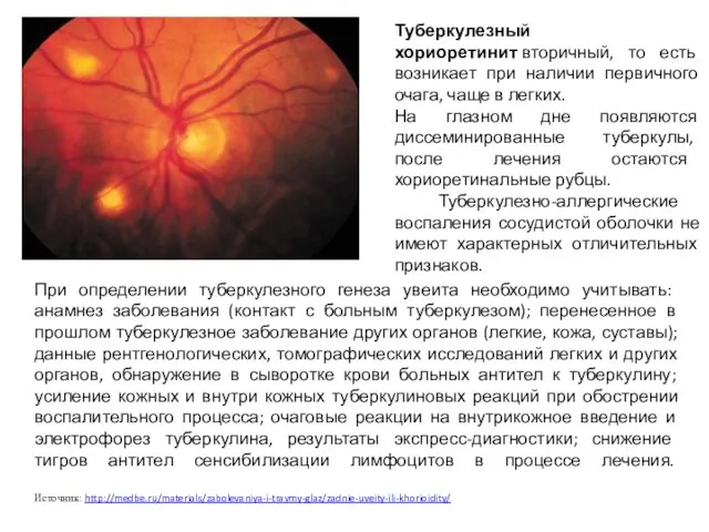 Туберкулезный хориоретинит вторичный, то есть возникает при наличии первичного очага, чаще