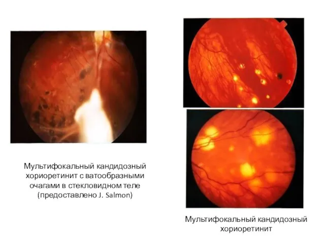 Мультифокальный кандидозный хориоретинит с ватообразными очагами в стекловидном теле (предоставлено J. Salmon) Мультифокальный кандидозный хориоретинит