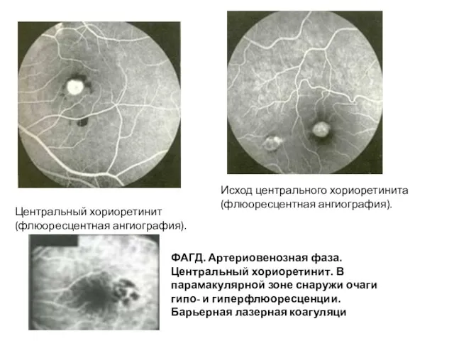 Центральный хориоретинит (флюоресцентная ангиография). Исход центрального хориоретинита (флюоресцентная ангиография). ФАГД. Артериовенозная