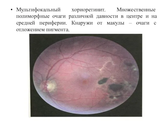 Мультифокальный хориоретинит. Множественные полиморфные очаги различной давности в центре и на