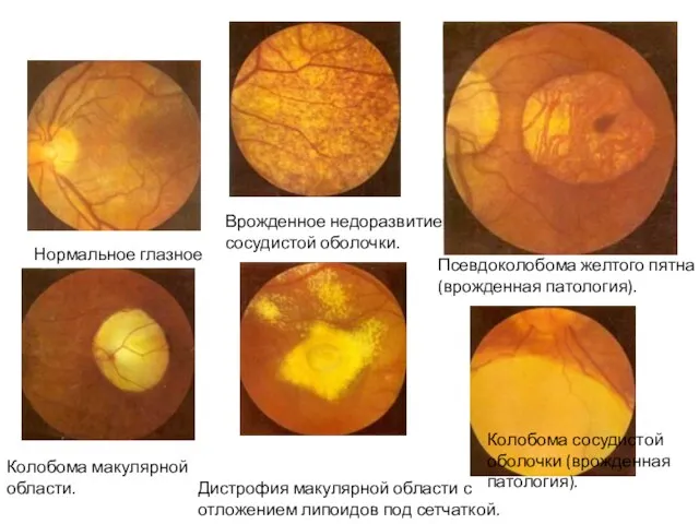 Нормальное глазное дно. Врожденное недоразвитие сосудистой оболочки. Псевдоколобома желтого пятна (врожденная
