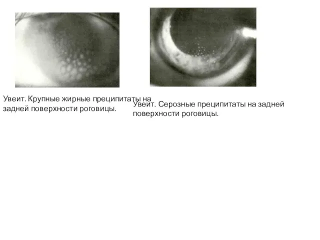Увеит. Крупные жирные преципитаты на задней поверхности роговицы. Увеит. Серозные преципитаты на задней поверхности роговицы.