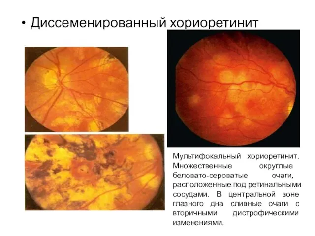 Диссеменированный хориоретинит Мультифокальный хориоретинит. Множественные округлые беловато-сероватые очаги, расположенные под ретинальными