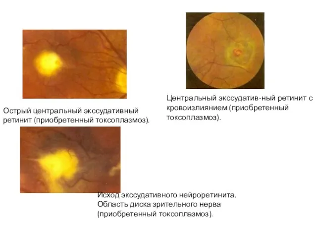 Острый центральный экссудативный ретинит (приобретенный токсоплазмоз). Центральный экссудатив-ный ретинит с кровоизлиянием