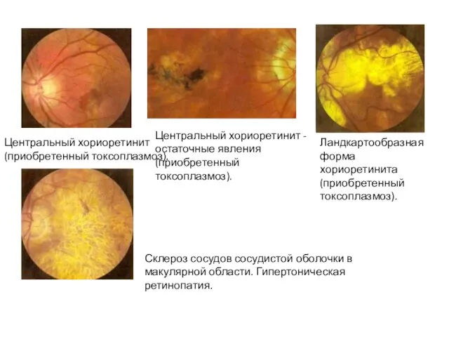 Центральный хориоретинит (приобретенный токсоплазмоз). Центральный хориоретинит - остаточные явления (приобретенный токсоплазмоз).