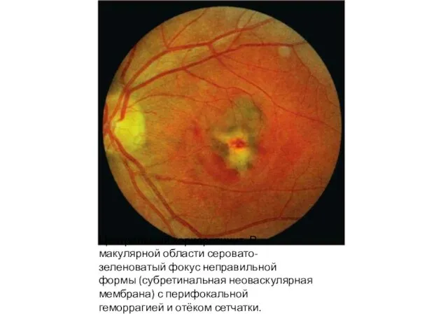 Центральный хориоретинит. В макулярной области серовато-зеленоватый фокус неправильной формы (субретинальная неоваскулярная