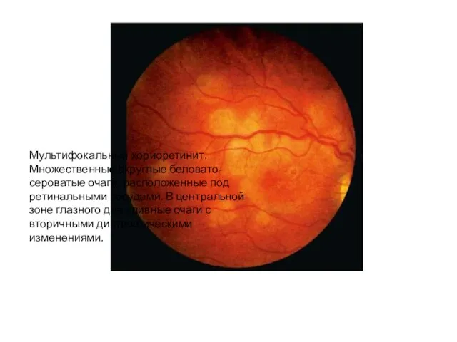Мультифокальный хориоретинит. Множественные округлые беловато-сероватые очаги, расположенные под ретинальными сосудами. В