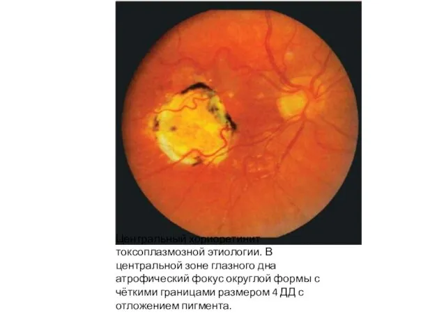 Центральный хориоретинит токсоплазмозной этиологии. В центральной зоне глазного дна атрофический фокус