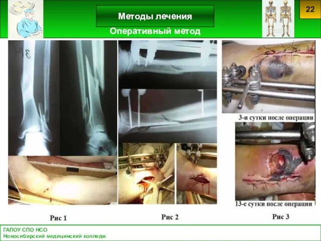 Оперативный метод ГАПОУ СПО НСО Новосибирский медицинский колледж Методы лечения 22 Оперативный метод