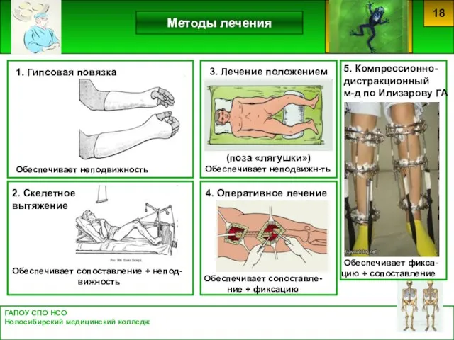 Обеспечивает неподвижность ГАПОУ СПО НСО Новосибирский медицинский колледж Методы лечения 18