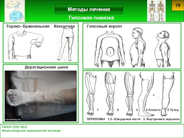 ГАПОУ СПО НСО Новосибирский медицинский колледж Методы лечения 19 Гипсовая повязка