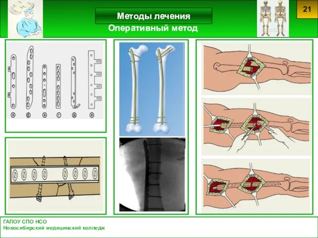 ГАПОУ СПО НСО Новосибирский медицинский колледж 21 Методы лечения Оперативный метод