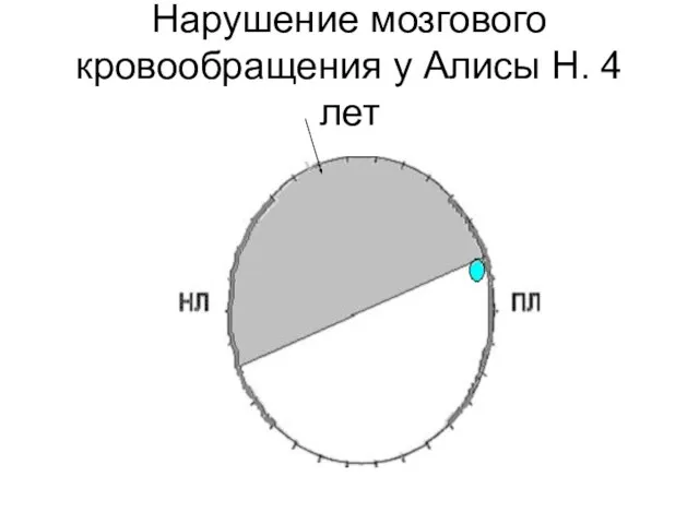 Нарушение мозгового кровообращения у Алисы Н. 4 лет