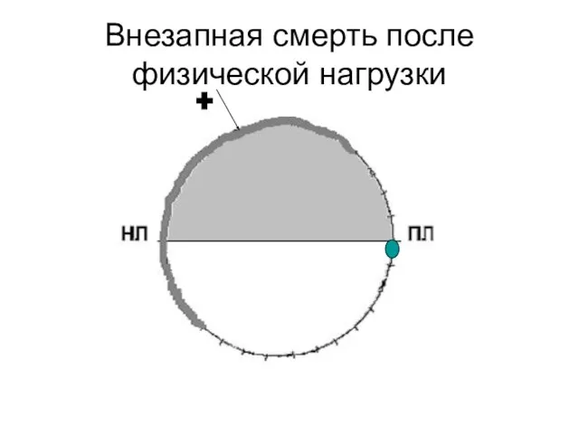 Внезапная смерть после физической нагрузки