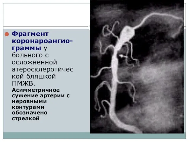 Фрагмент коронароангио-граммы у больного с осложненной атеросклеротической бляшкой ПМЖВ. Асимметричное сужение