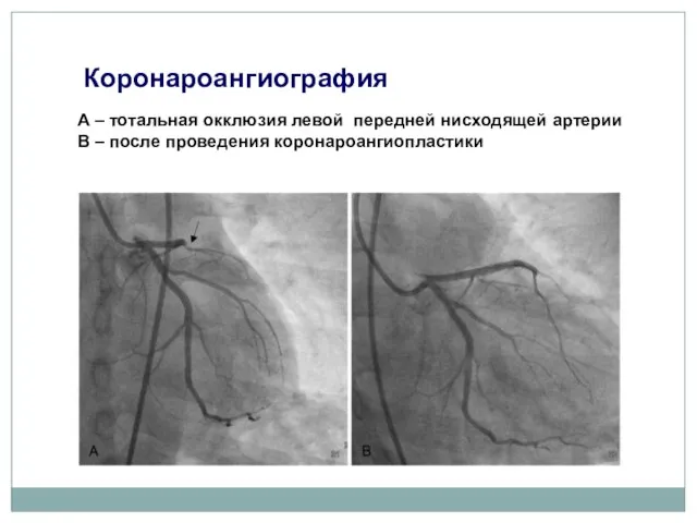А – тотальная окклюзия левой передней нисходящей артерии В – после проведения коронароангиопластики Коронароангиография