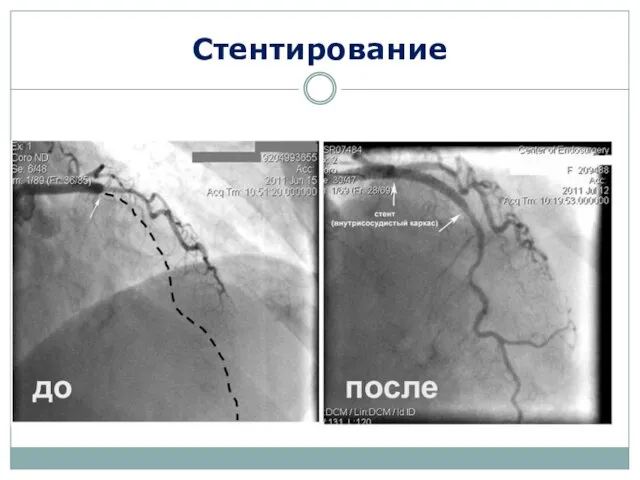 Стентирование