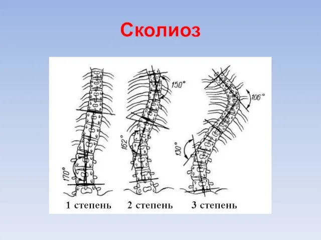 Сколиоз