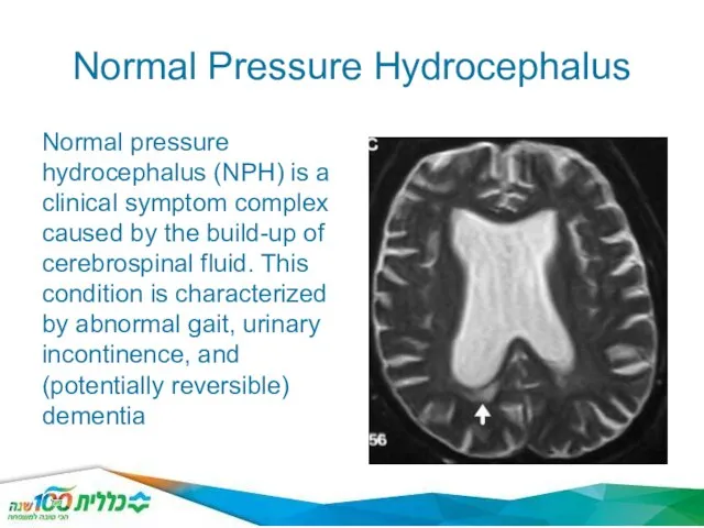 Normal Pressure Hydrocephalus Normal pressure hydrocephalus (NPH) is a clinical symptom