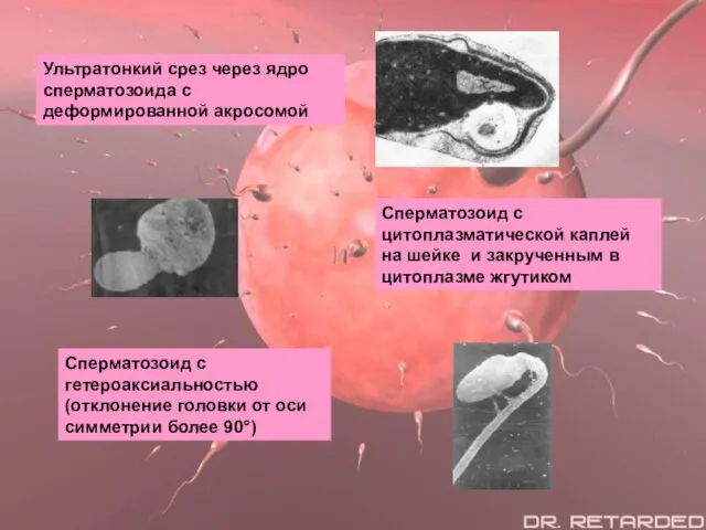 Ультратонкий срез через ядро сперматозоида с деформированной акросомой Сперматозоид с цитоплазматической