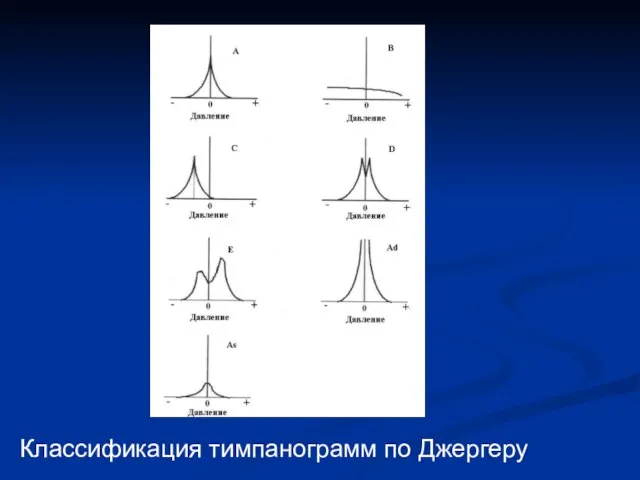 Классификация тимпанограмм по Джергеру