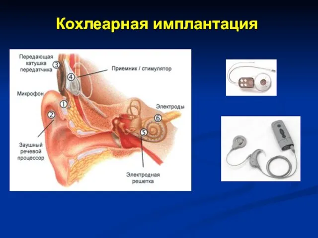 Кохлеарная имплантация