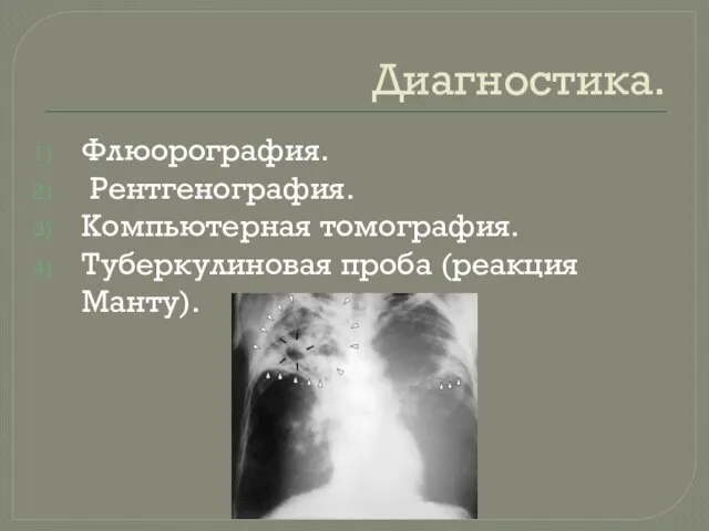 Диагностика. Флюорография. Рентгенография. Компьютерная томография. Туберкулиновая проба (реакция Манту).