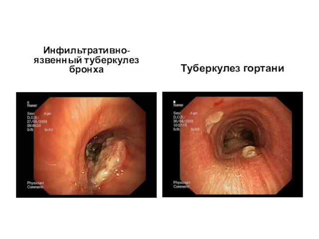Инфильтративно-язвенный туберкулез бронха Туберкулез гортани